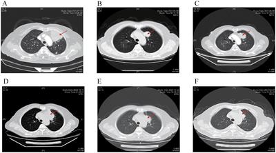 Potential therapeutic option for EGFR-mutant small cell lung cancer transformation: a case report and literature review